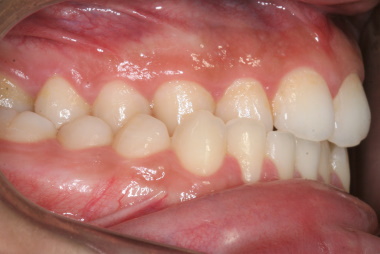 Posterior Crossbite